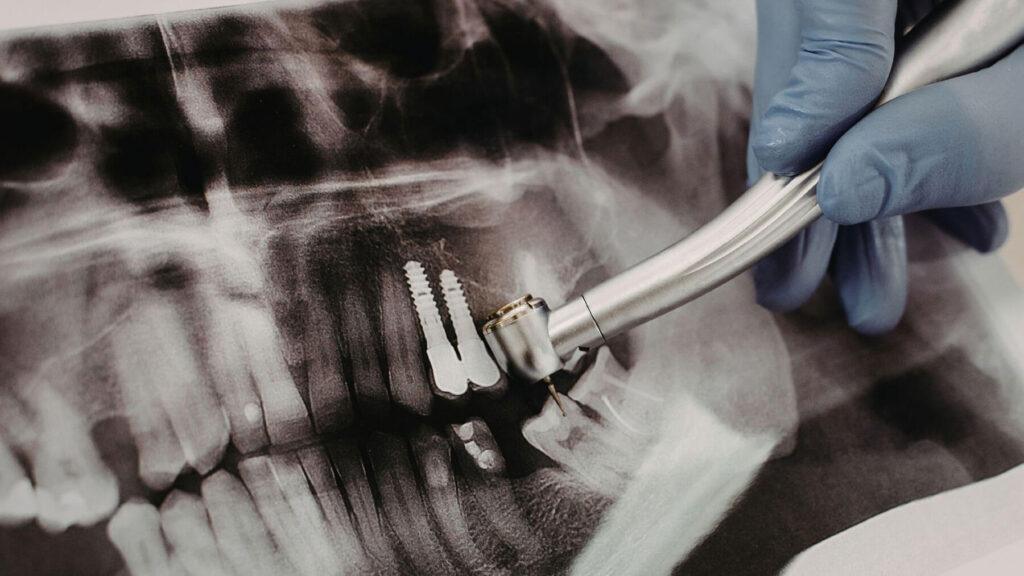 X-ray for Tooth Extraction