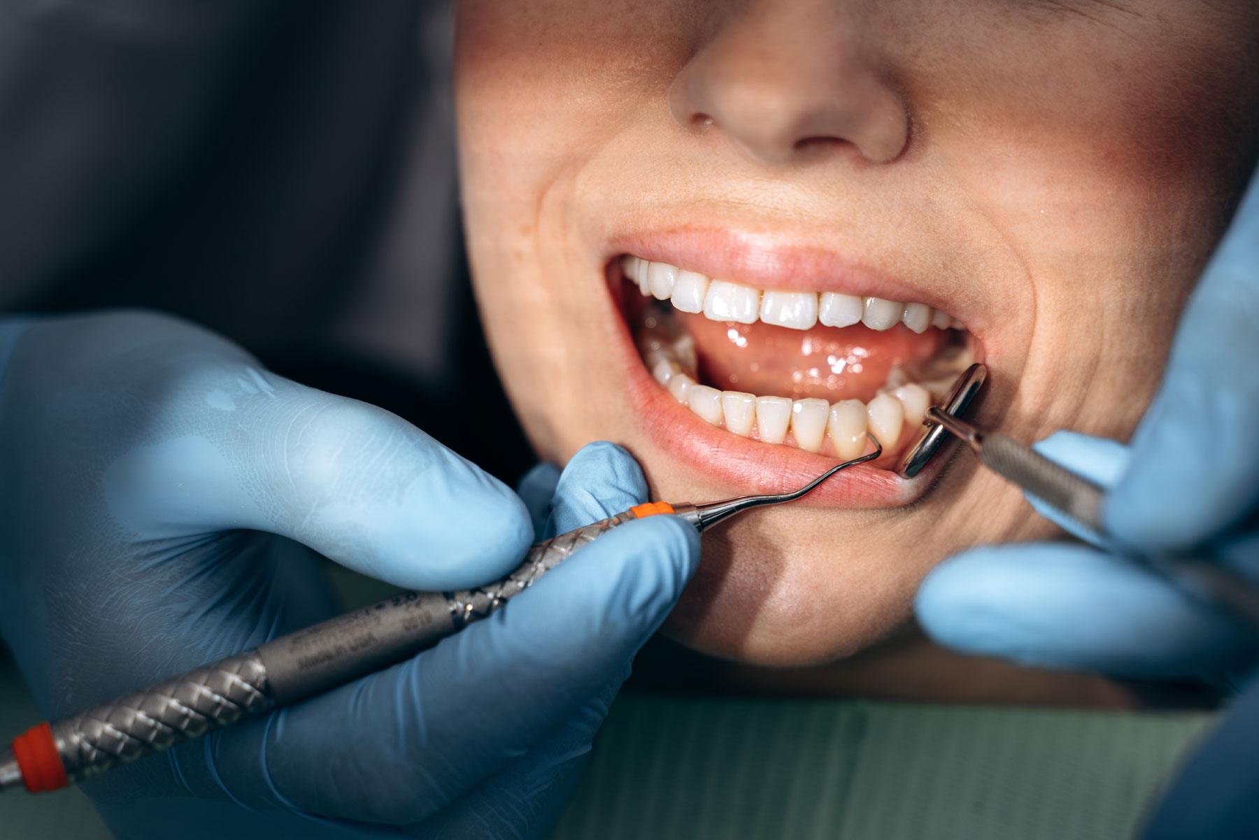 dental infection