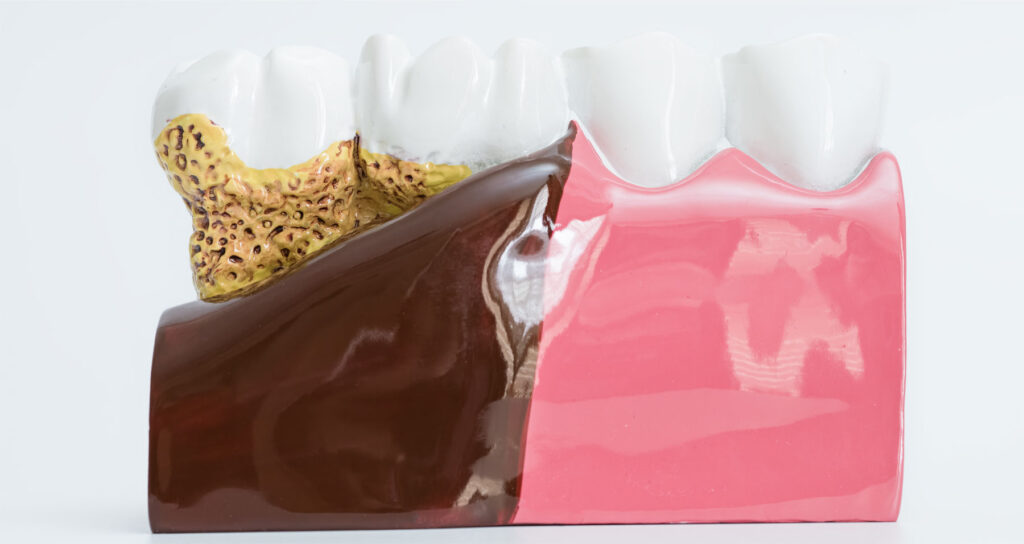 at-home whitening risks and enamel sensitivity