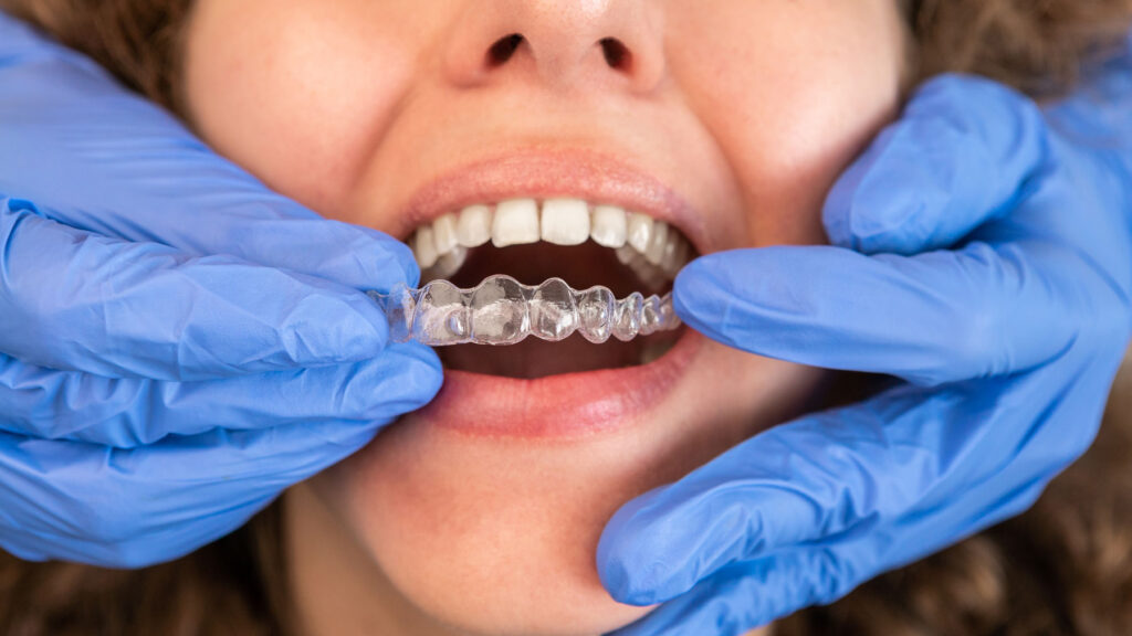 smile transformation after clear aligner therapy