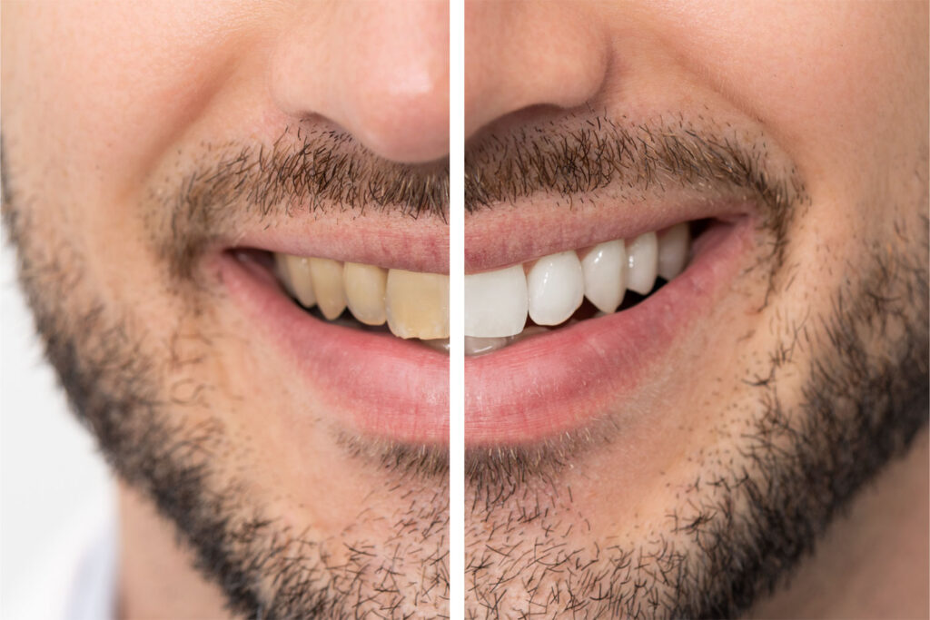comparison of professional whitening vs at-home whitening