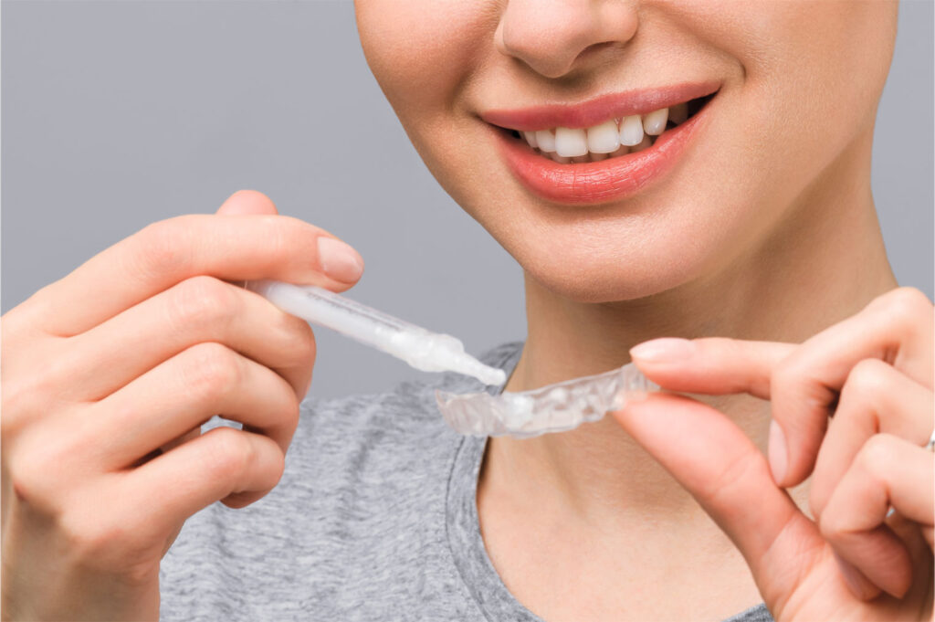 professional teeth whitening in Carlsbad