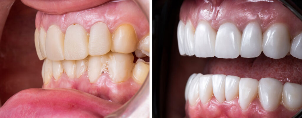 before and after porcelain veneers