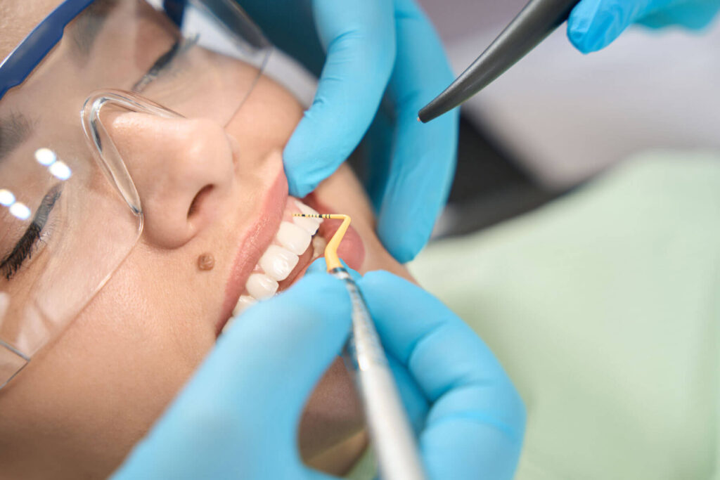 Dental Bonding in Carlsbad California – Smiles For Health dental clinic Near San Marcos, Oceanside, Winter Warm, Farr, Fallbrooks, San Diego, Solana, Pala Mesa, Leucadia, Mira Costa, Vista, Fairbanks, Carlsbad Village, Hidden Meadows