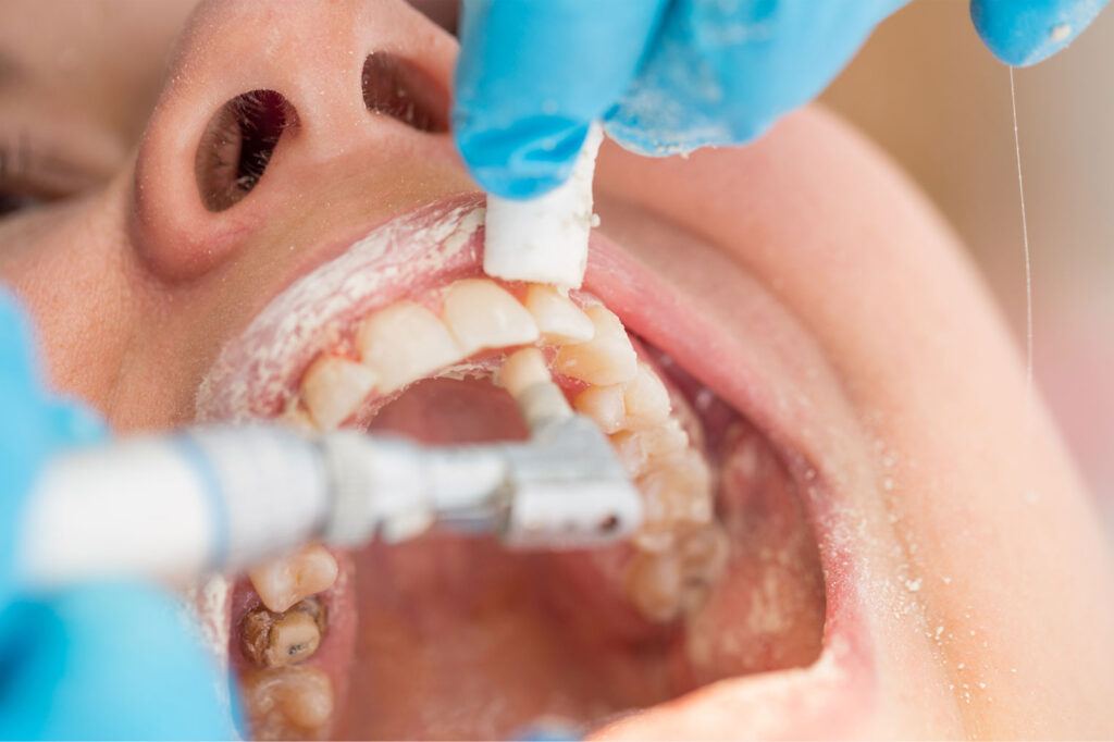 early cavity symptoms