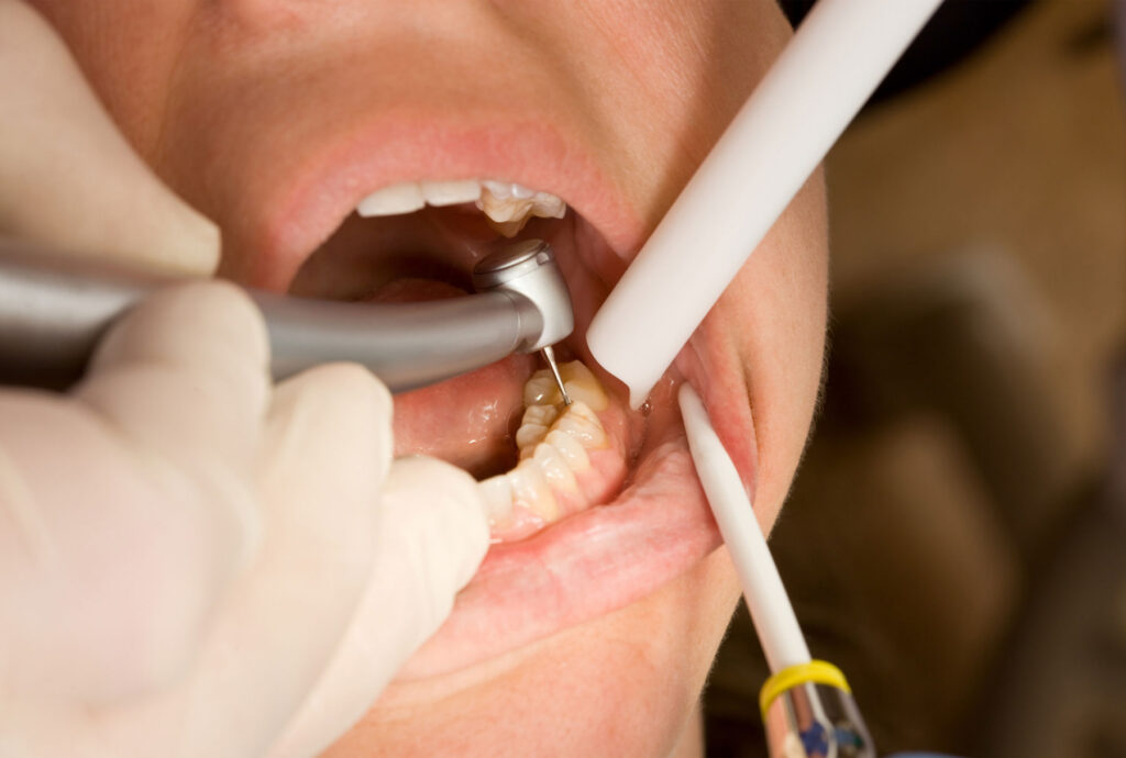 dentist in Carlsbad cavity care