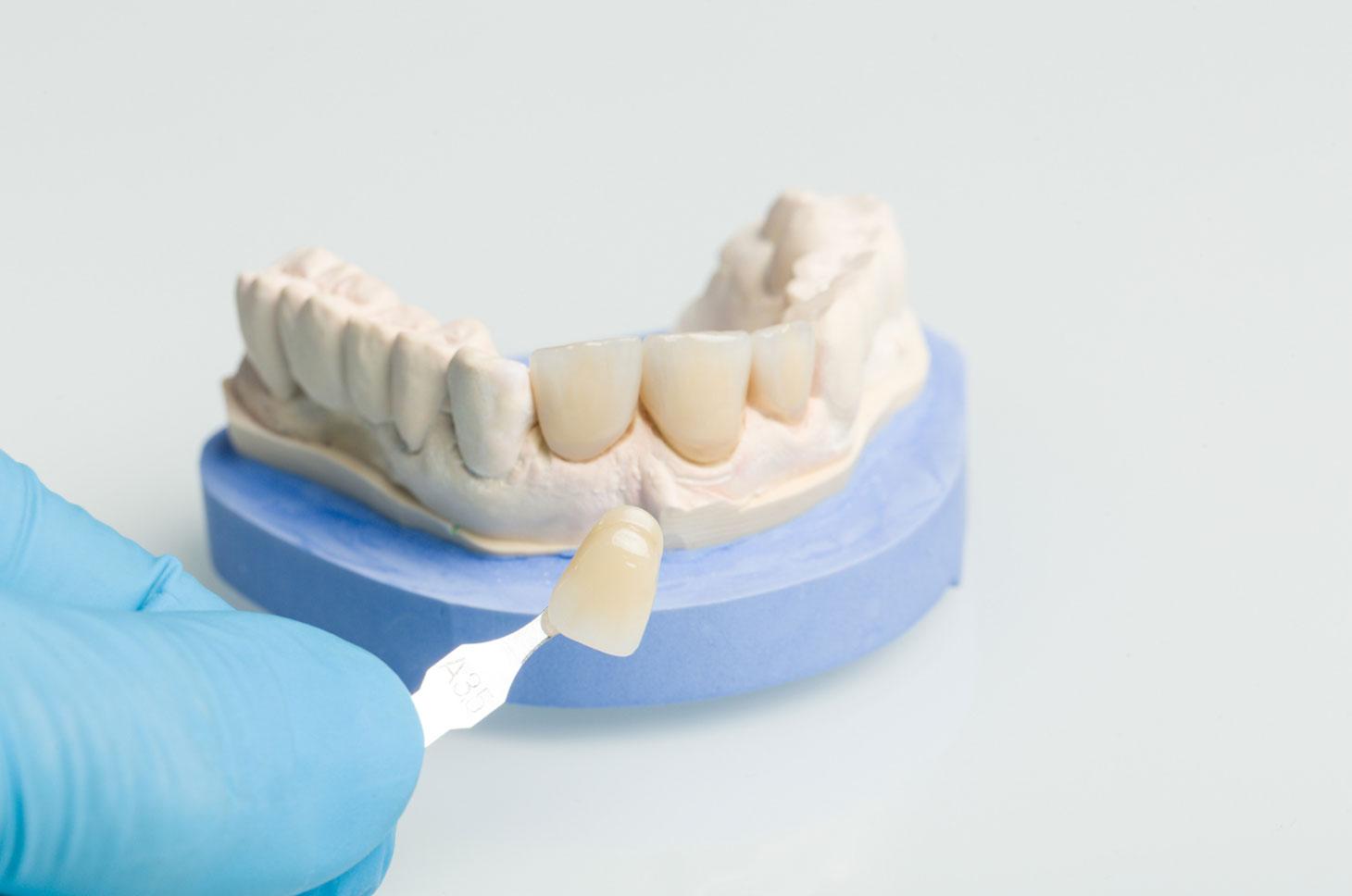 dentist applying veneers