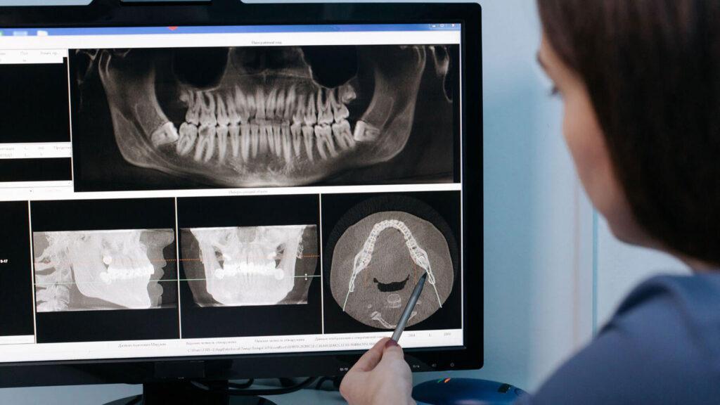 Do X-Rays Confirm If All Wisdom Teeth Were Fully Removed
