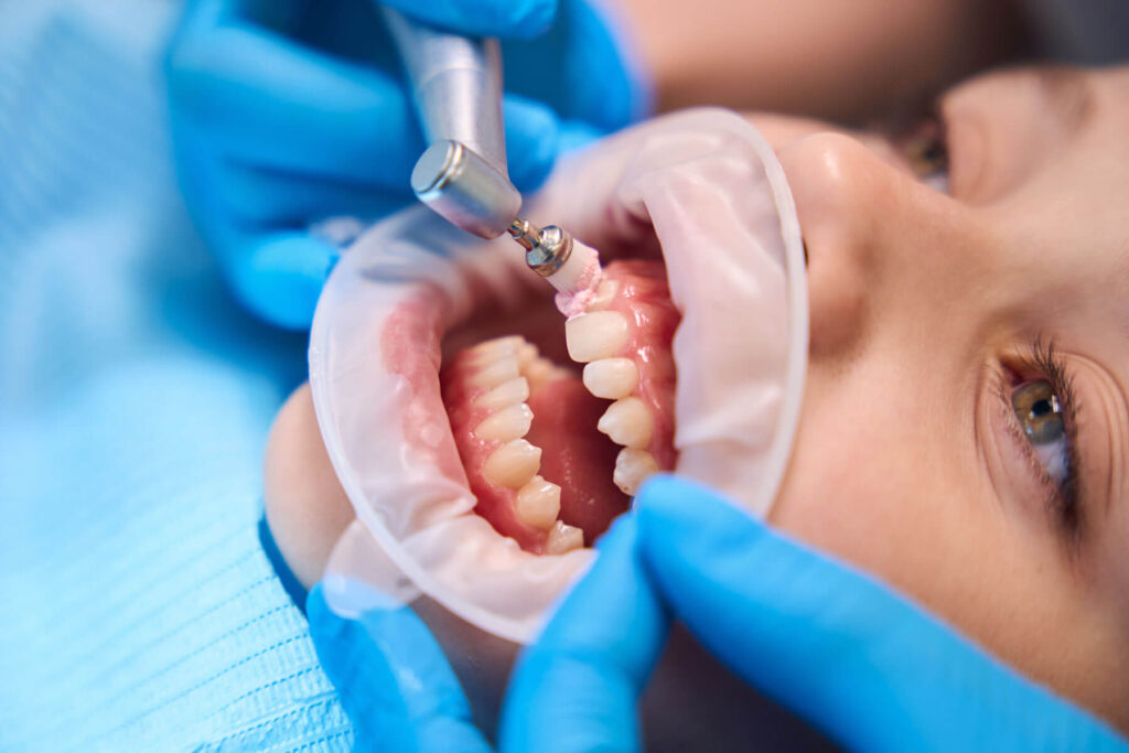 Fluoride Treatment in Carlsbad California – Smiles For Health dental clinic Near San Marcos, Oceanside, Winter Warm, Farr, Fallbrooks, San Diego, Solana, Pala Mesa, Leucadia, Mira Costa, Vista, Fairbanks, Carlsbad Village, Hidden Meadows