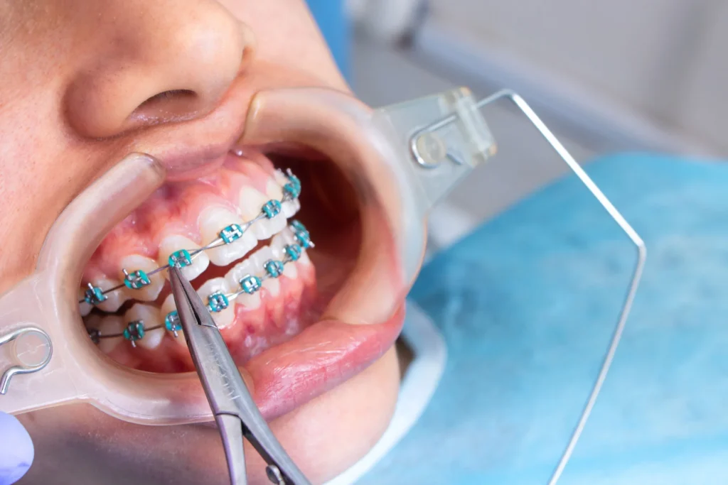 Advantages Over Traditional Braces