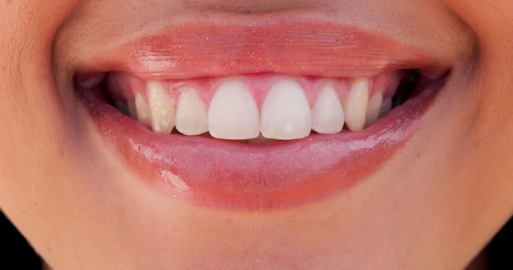 Benefits of Saving Your Natural Tooth with Root Canals in Carlsbad