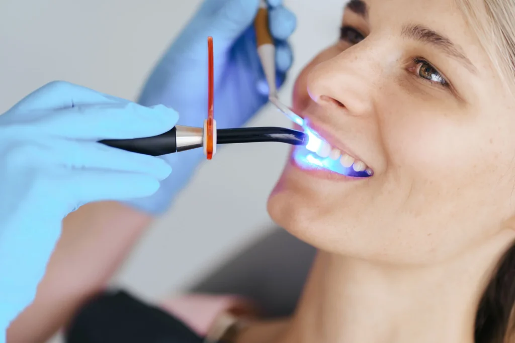 Dental Bonding Procedure in Carlsbad