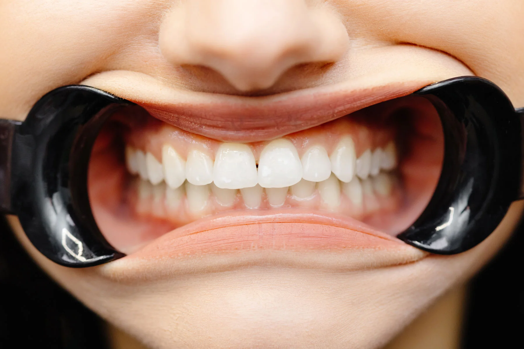 Dental Bonding in Calrsbad