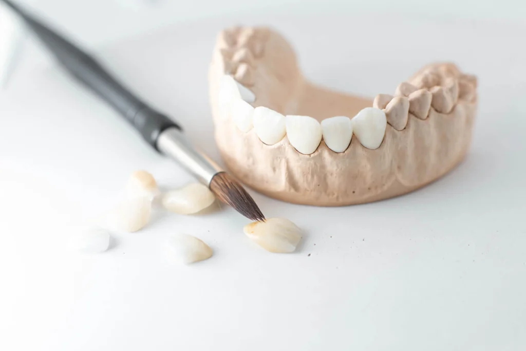 Who Can Benefit from Dental Crowns Treatment in Carlsbad
