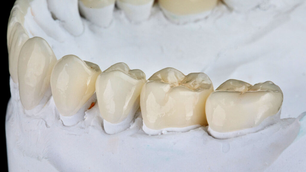 Dental-Molding-Carlsbad