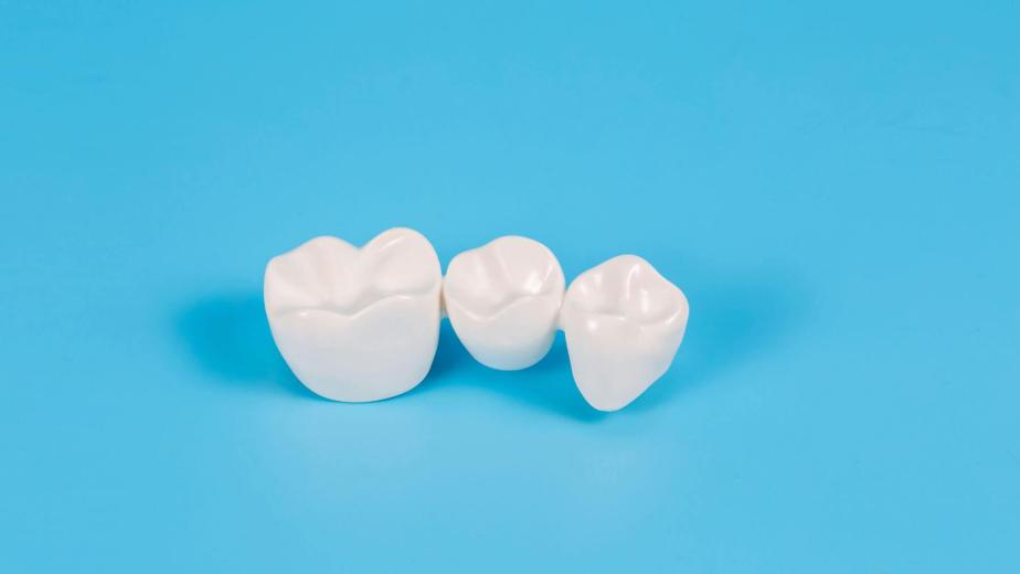 Dental-Crowns-and-Dental-Bridges-in-Carlsbad