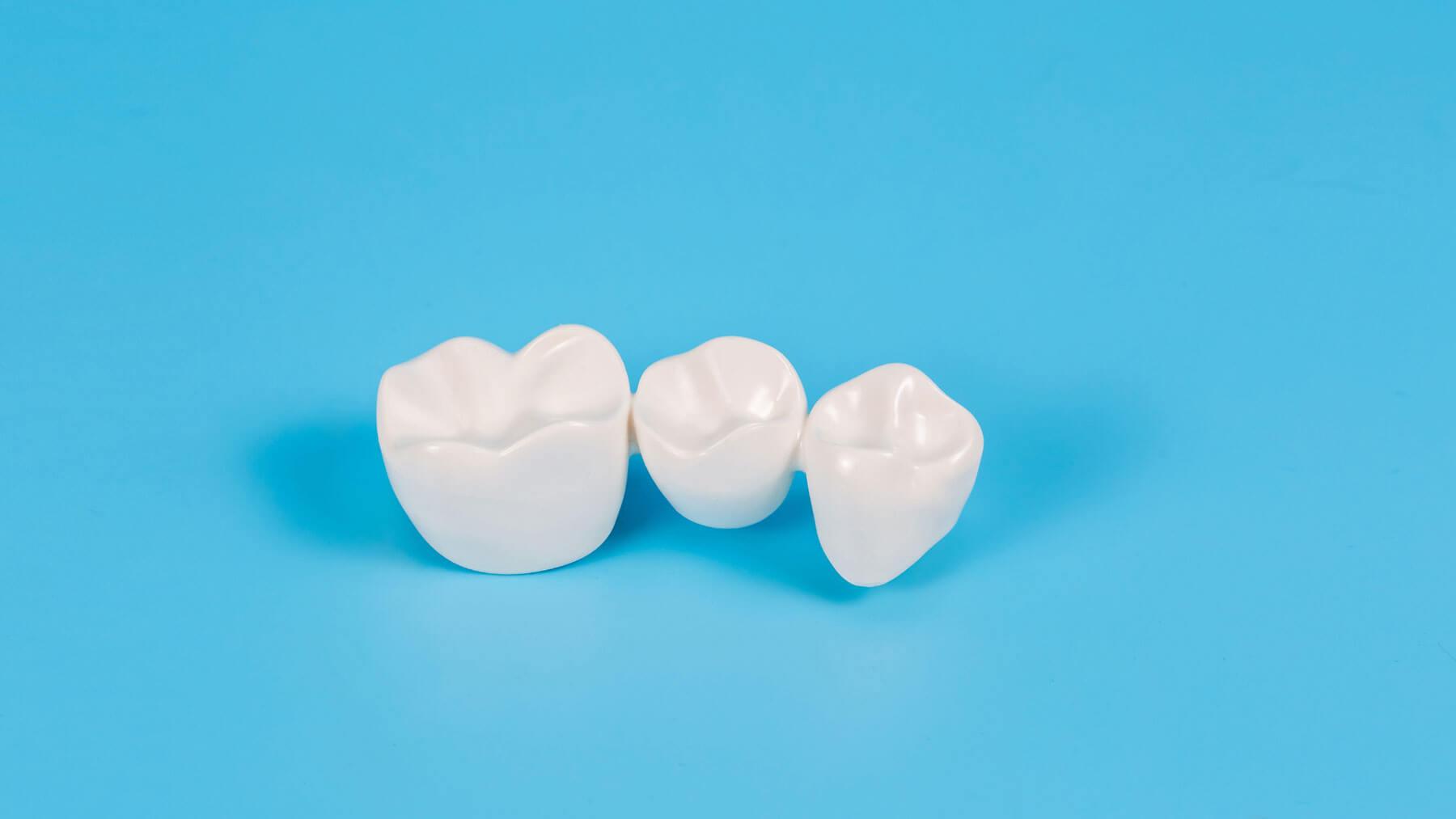 Dental-Crowns-and-Dental-Bridges-in-Carlsbad