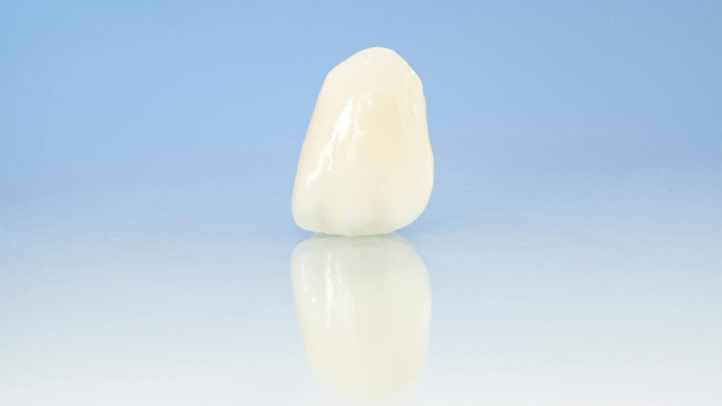 Dental-Crowns-in-Carlsbad