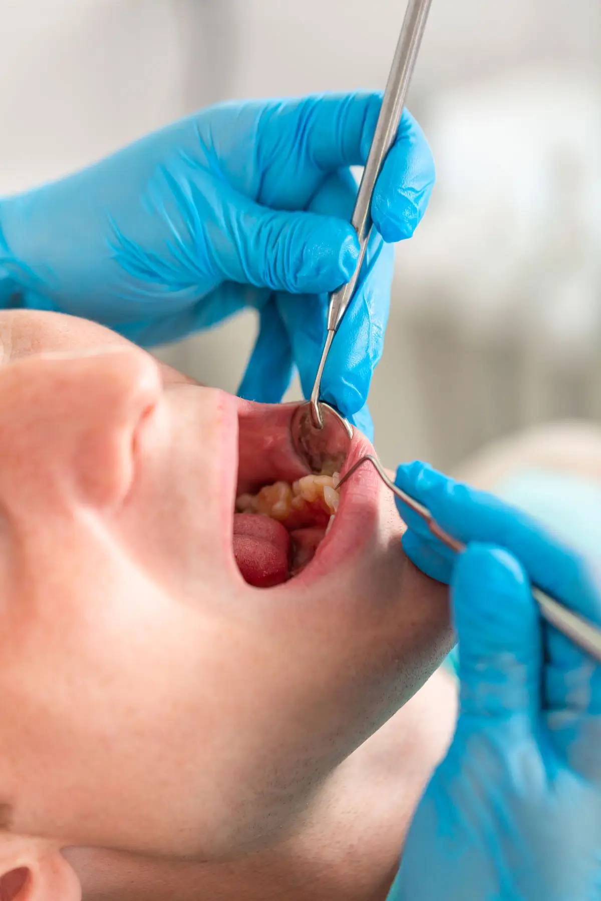 Dental Extractions