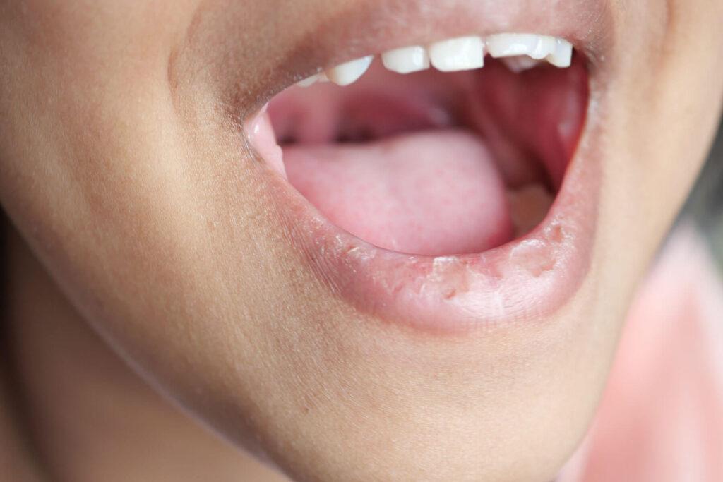 Dry-Mouth-Caused-for-Stress