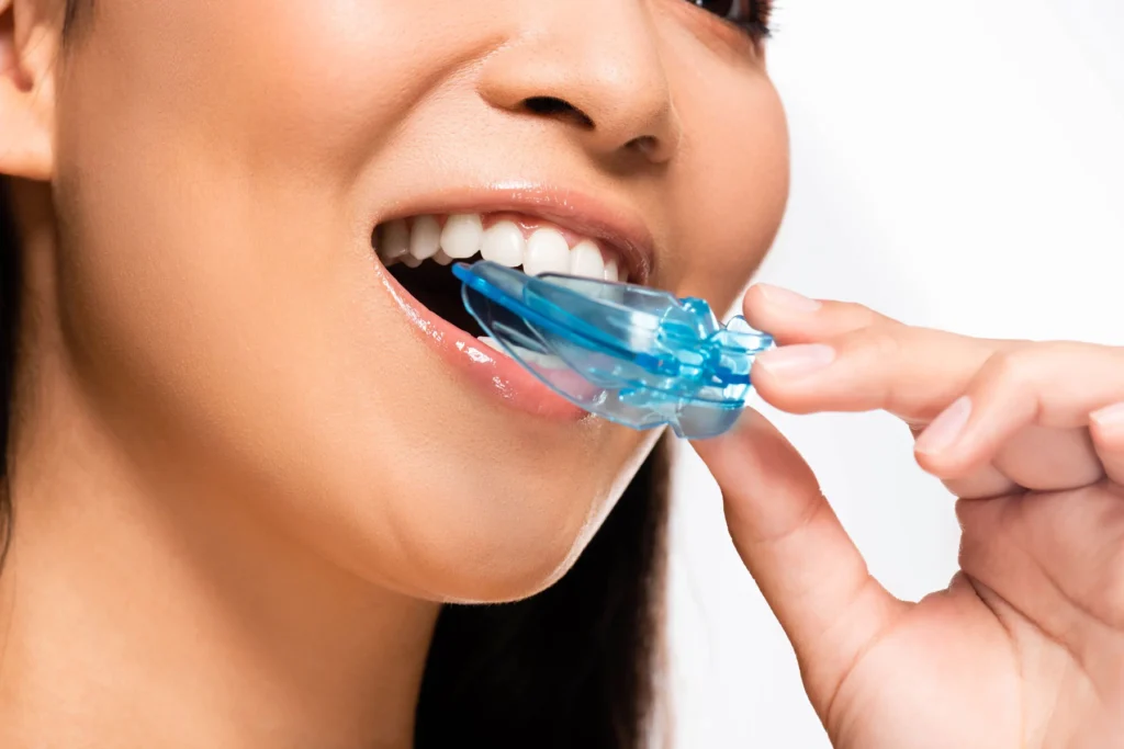Mouthguard-for-Care-Dental-Veneers