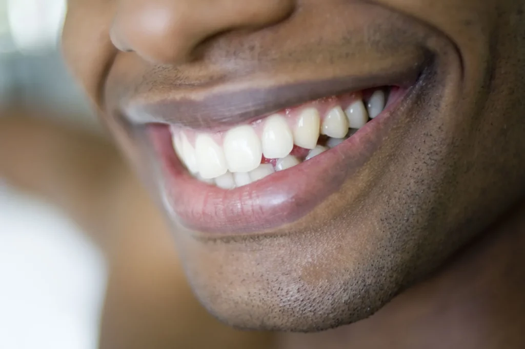 Everyday Comfort with Onlays and Inlays in Carlsbad