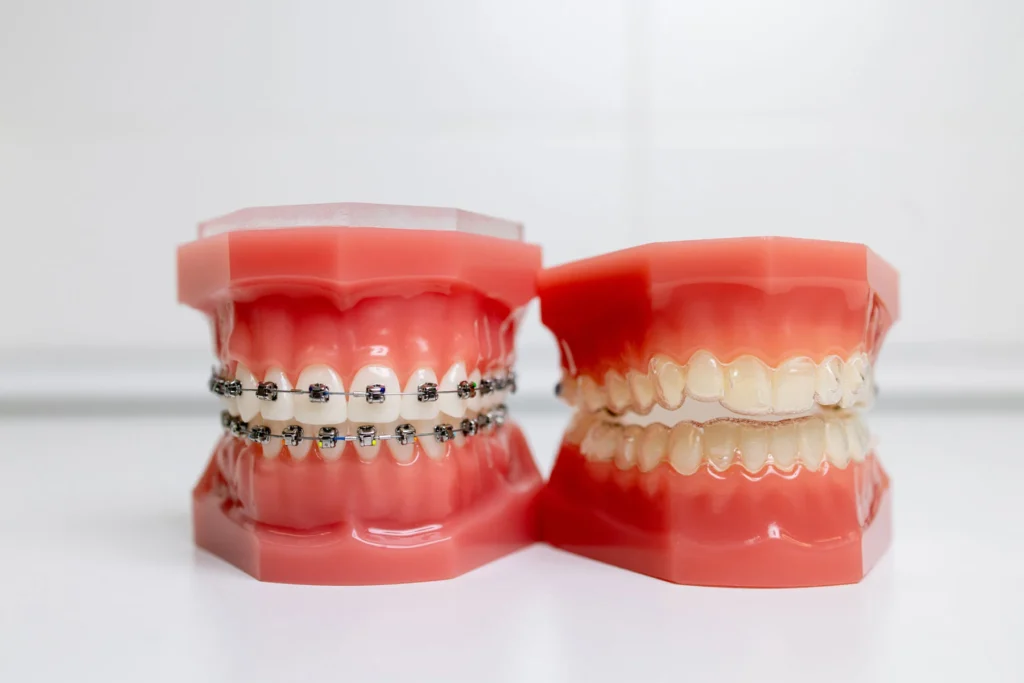 SureSmile Aligners Carlsbad vs. Traditional Braces