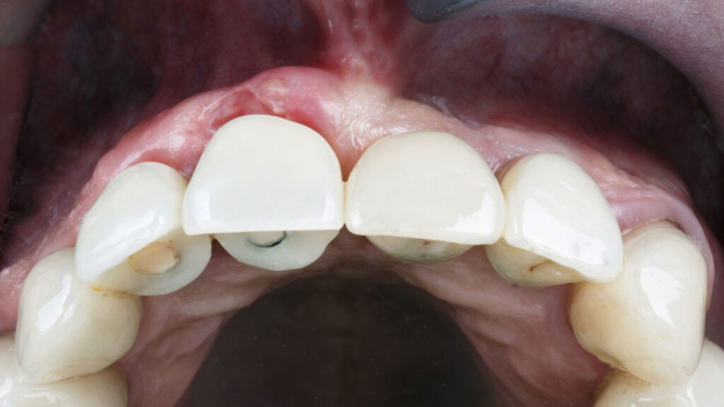 When Do You Need a Dental Crown?