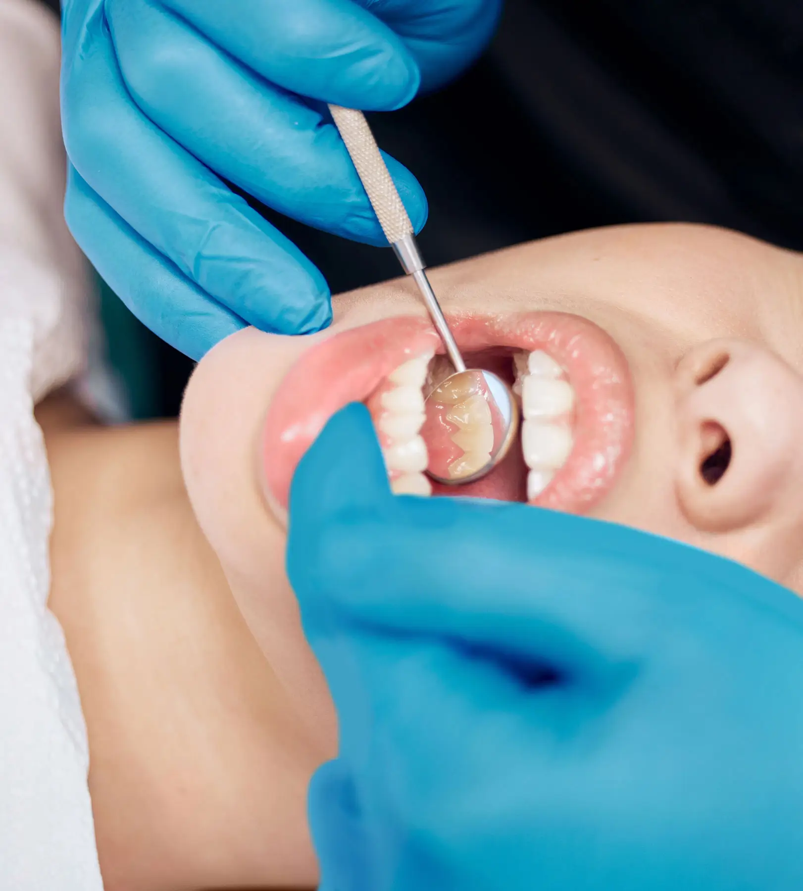 dental sealants Carlsbad