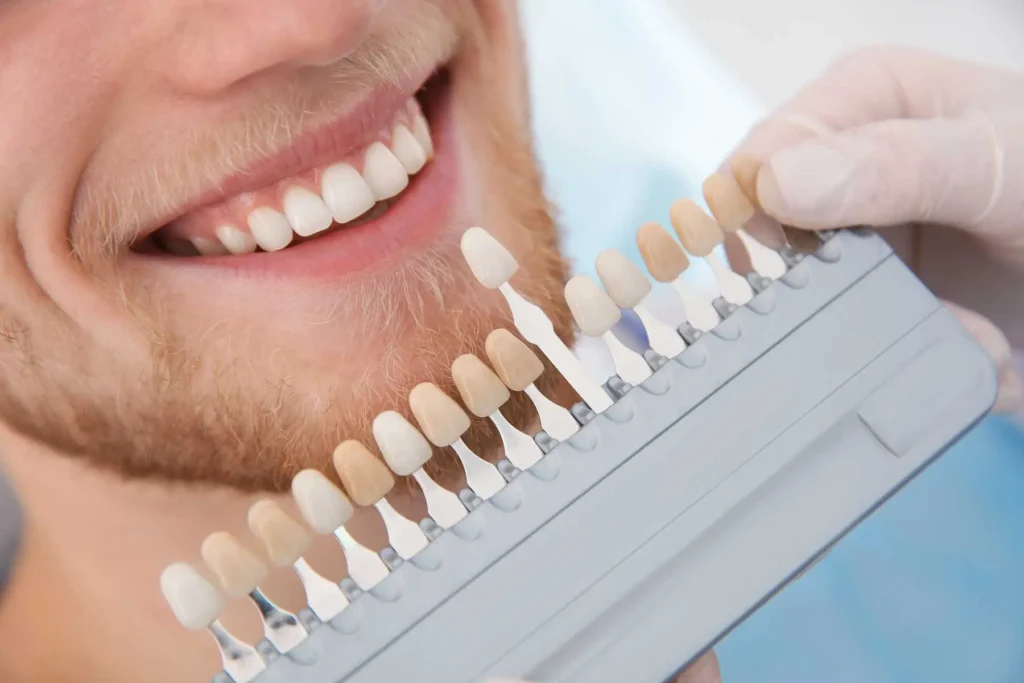 Cosmetic-Dental-Veneers-in-Carlsbad