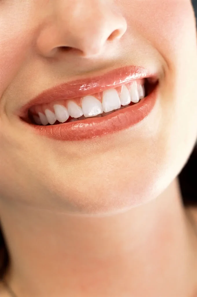 Dental-Bonding-Carlsbad-