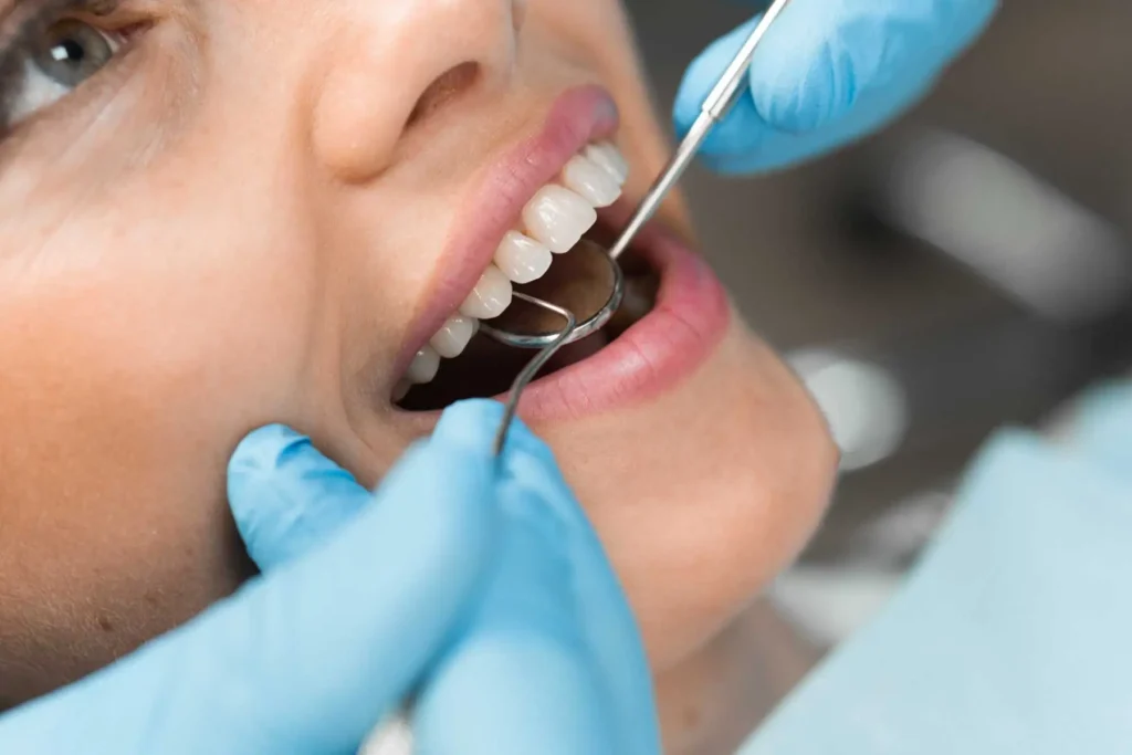 Dental-Bonding-In-Carlsbad