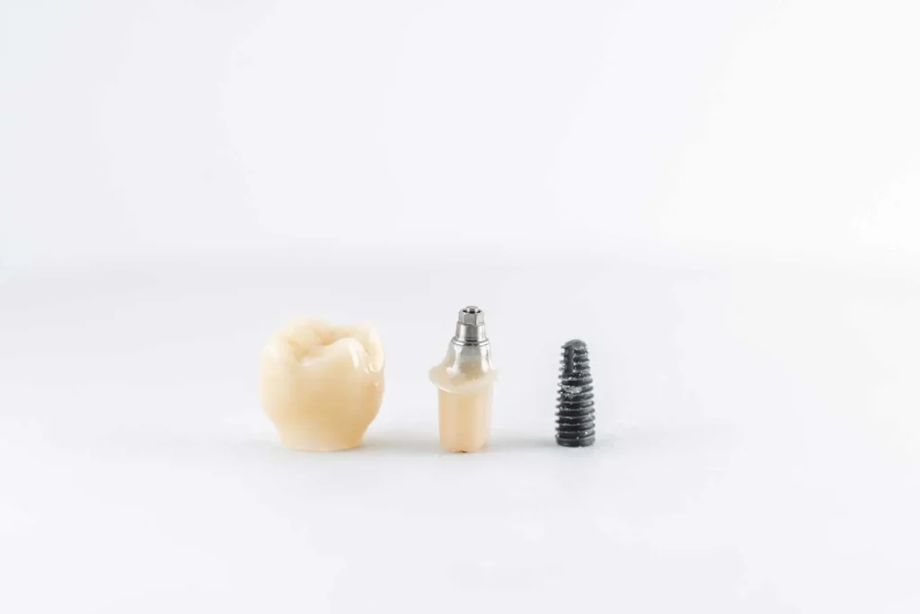 Dental-Implant-in-Carlsbad