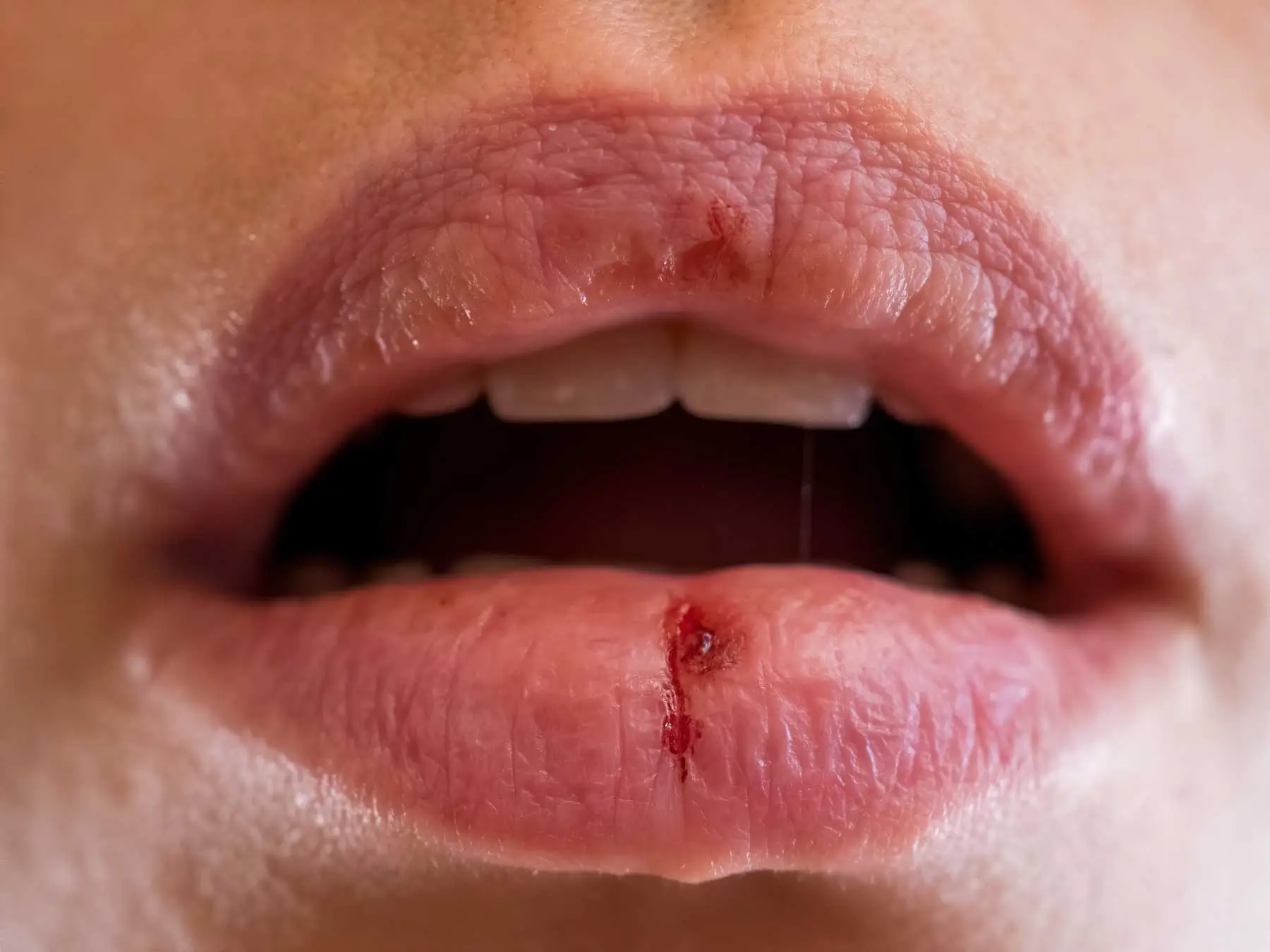 Dry-Lips-For-Dry Mouth