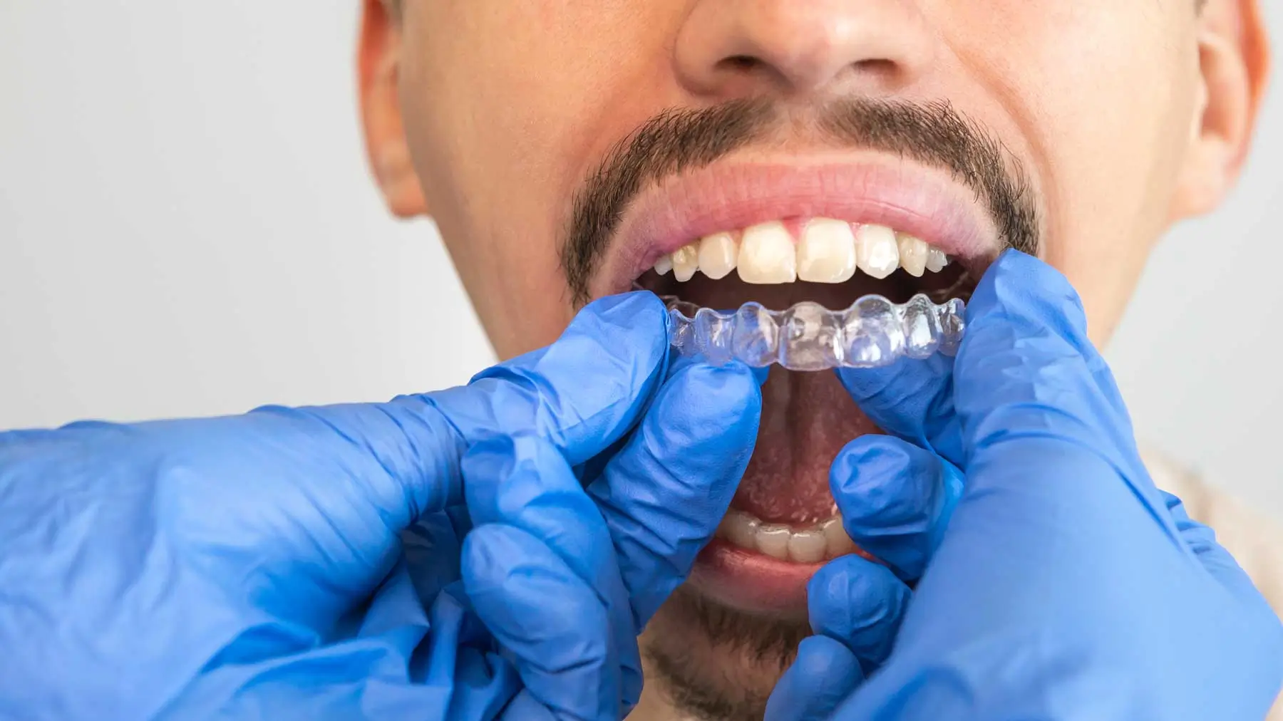 Teeth-Aligners-in-Carlsbad