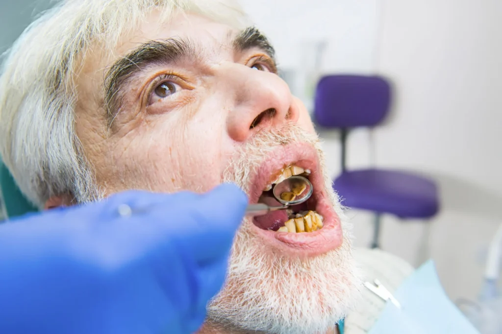 Decaying Tooth Filling Escondido