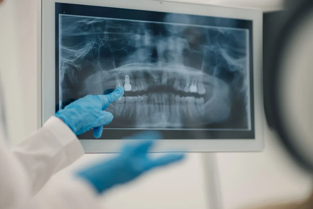 Decaying-Tooth-