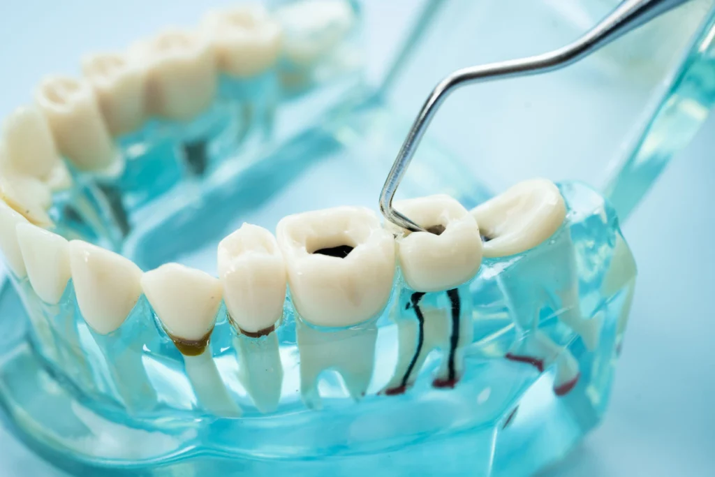 Why Many Patients Prefer Tooth-Colored Fillings
