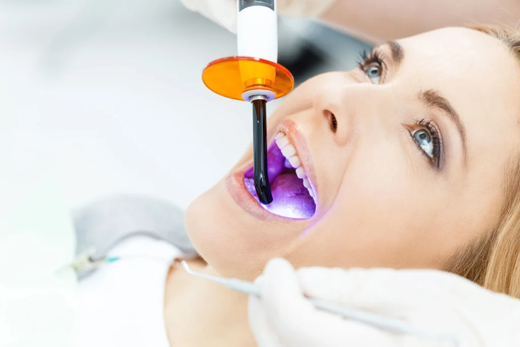 Cosmetic Dental Bonding San Diego