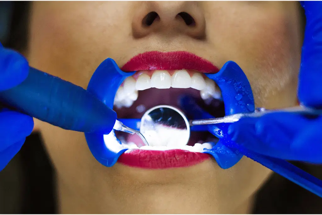Cosmetic Dental Bonding San Diego