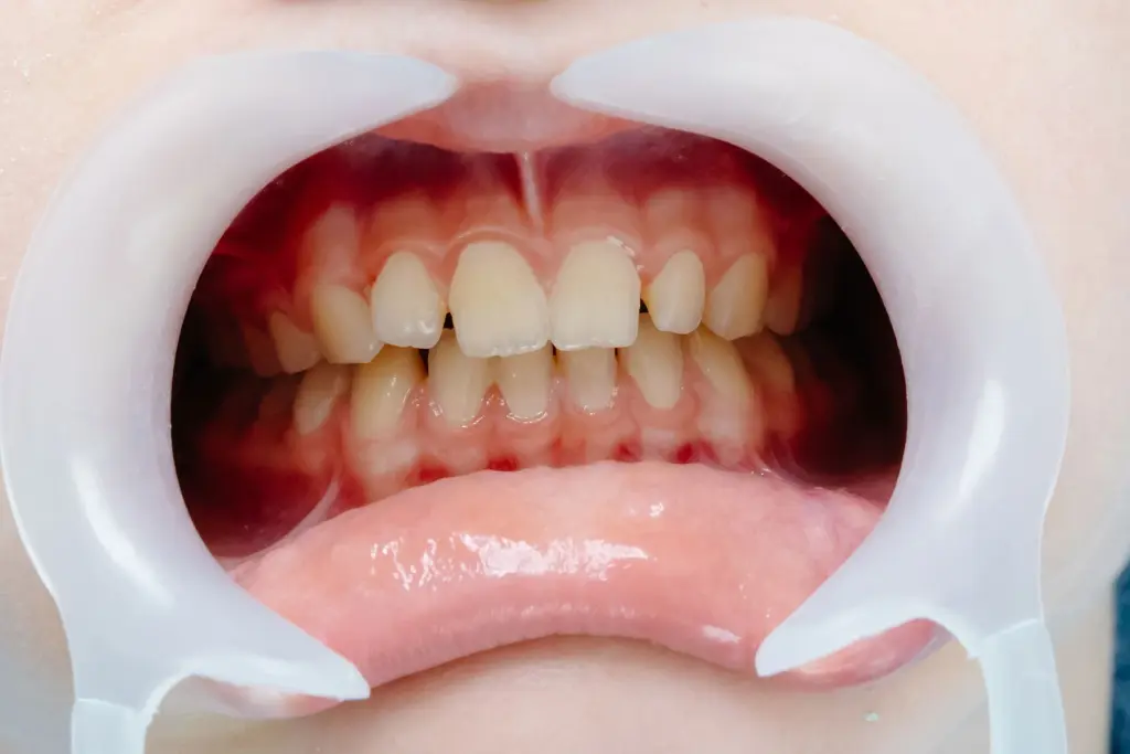 If-Your-Gums-Don’t-Hurt,-They’re-Healthy