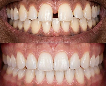 clear-aligners-before-after-smiles-for-health