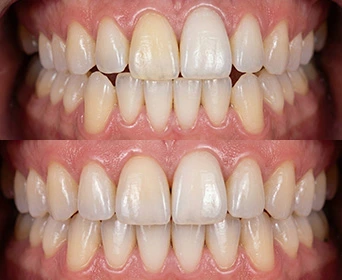 clear-aligners-before-after-carlsbad