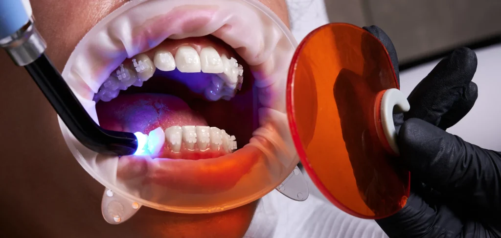 cosmetic dental bonding San Diego procedure