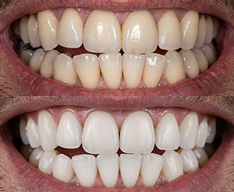 Professional-whitening-before-vs-after-in-carlsbad