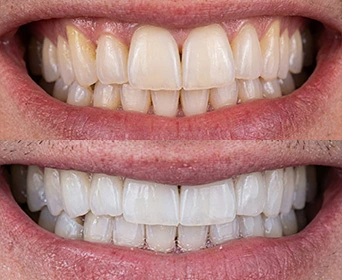 Teeth-whitening-in-carlsbad-after-vs-before