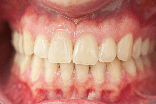 Can Wisdom Teeth Grow Back?