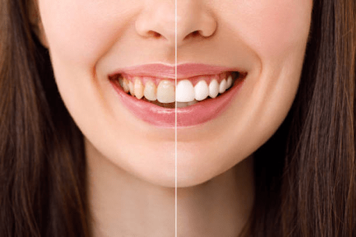 Why Are My Teeth Yellow When I Brush Them Everyday?