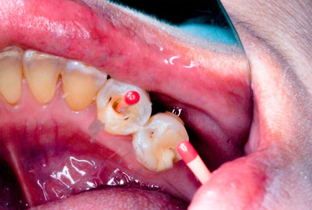 dental protection after root canal treatment