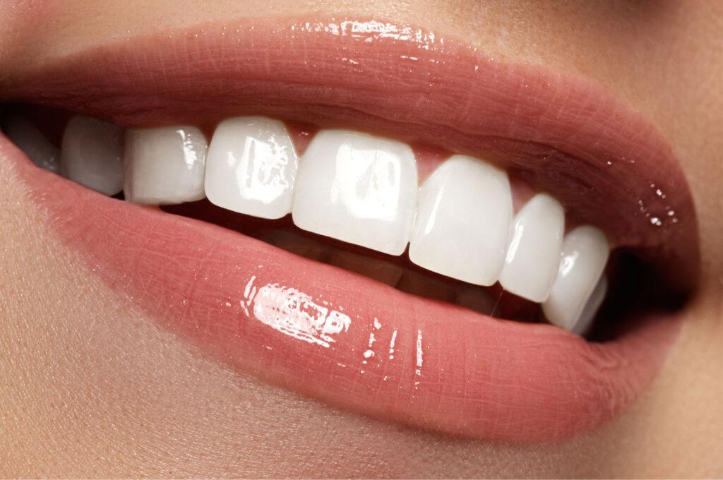 in-office teeth whitening at dental clinic